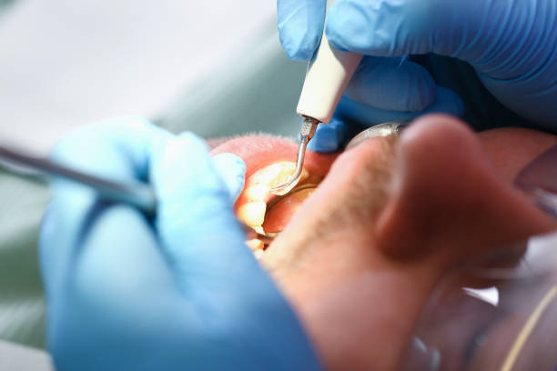 Best Knocked-Out Tooth (Avulsed Tooth) Treatment in Unionville, TN